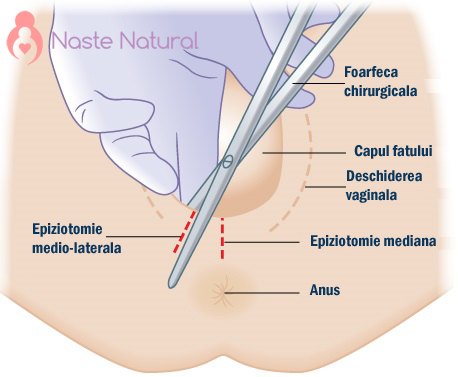 Epiziotomie-nastere-naturala-poze