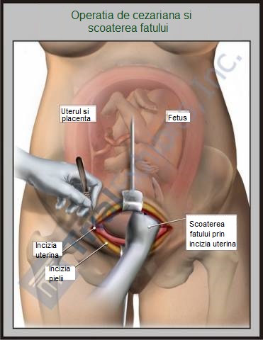Incizia in muschi abdominal si uter, la operatia de cezariana Incizia in muschi abdominal si uter, la operatia de cezariana