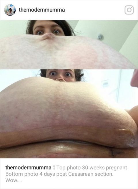 Mama care isi arata burta dupa cezariana