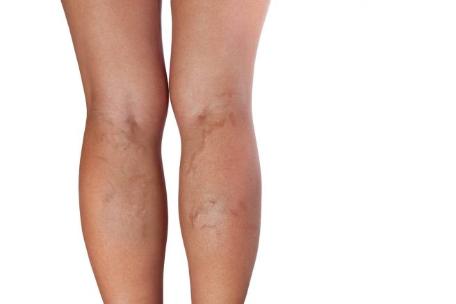 tratamentul picioarelor varicoase în timpul sarcinii cum de a determina venele varicoase interioare