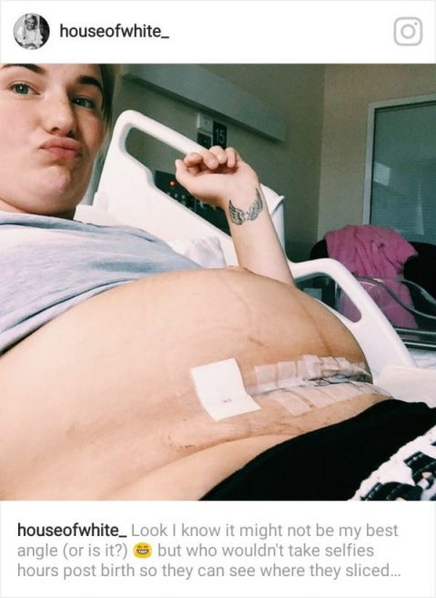 o mama care doar ce a nascut cu cicatricea de la cezariana vizibila