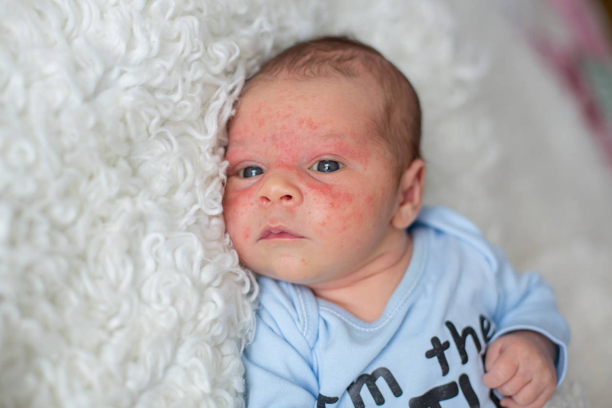 Totul despre hemangioamele infantile (petele roșii ale nou-născuților și sugarilor)