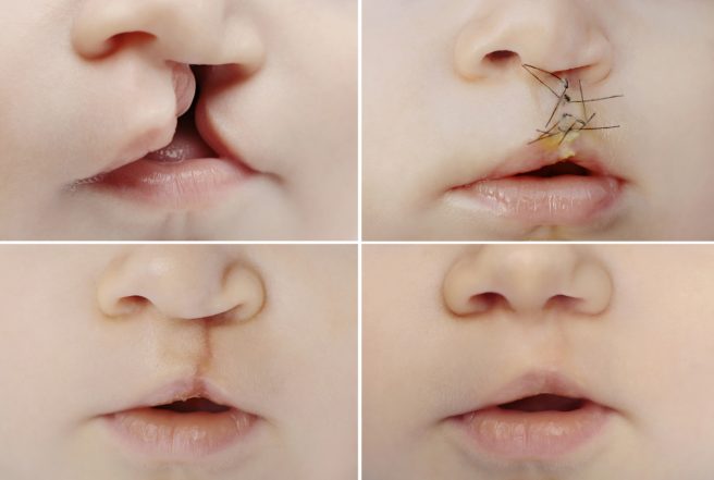 4 imagini care demonstreaza evolutia operatiei pentru buza de iepure