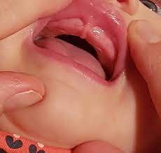 Why Upper Lip-Tie Isn't a Thing – Pondering